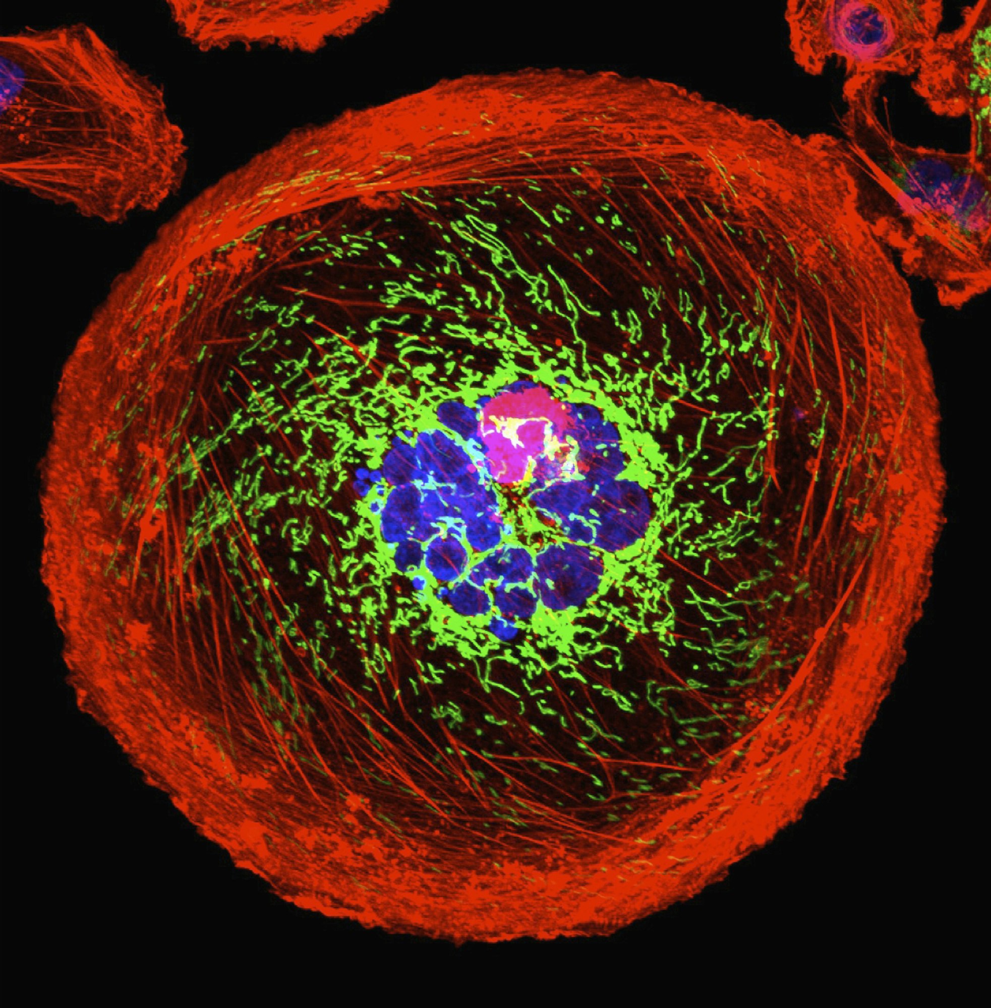 Microscopic image of polyploid giant cancer cell