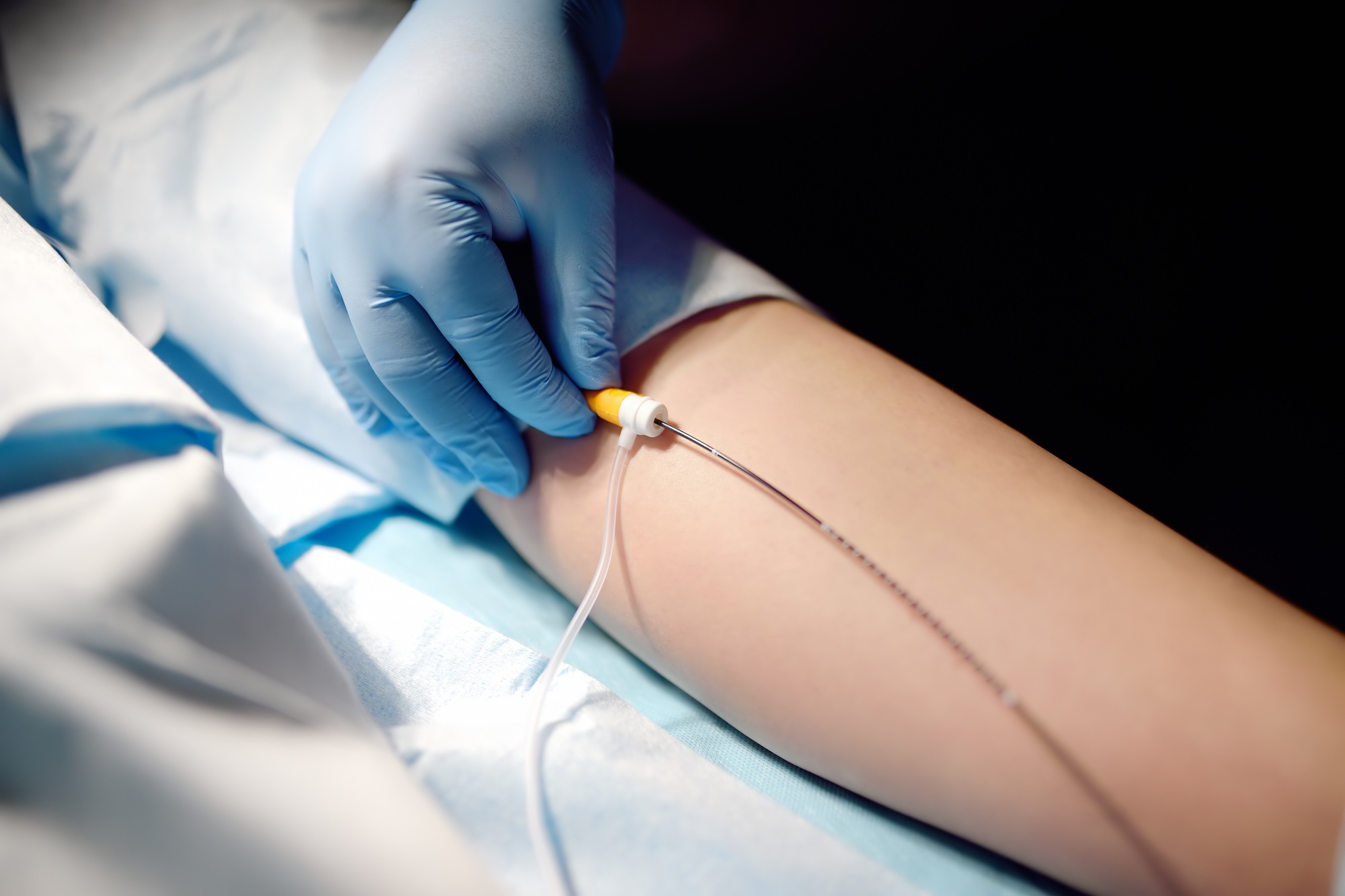 Professional vascular surgeon is in the operating room of the clinic during vein surgery.